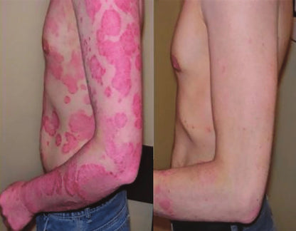 Prirodna Krema Za Psorijazu