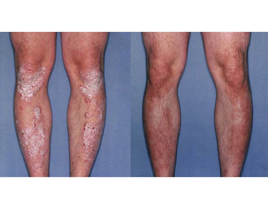 Prirodna Krema Za Psorijazu