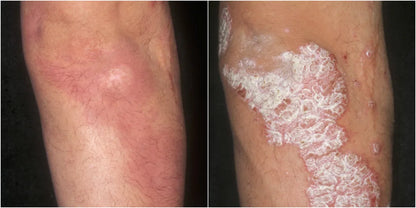 Prirodna Krema Za Psorijazu
